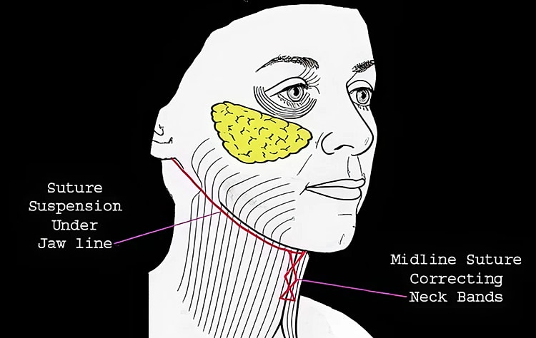 Facial rejuvenation suture techniques illustration.
