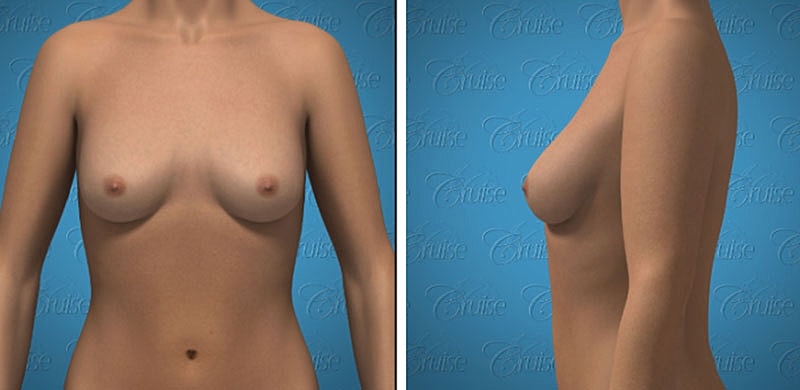 3D model of a female torso, front and side.
