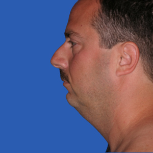 Before man's chin implant and neck lift - side view