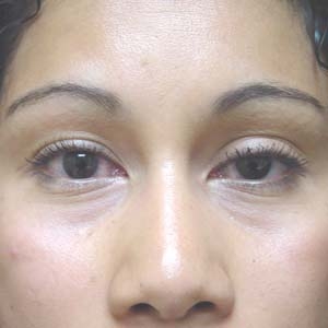 Before upper eyelid correction - front view