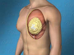 Male chest with fatty gynecomastia