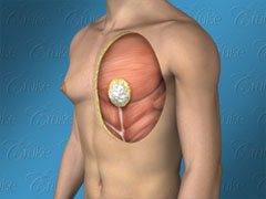Male chest with puffy nipple gynecomastia