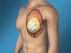 Male chest with classic gynecomastia