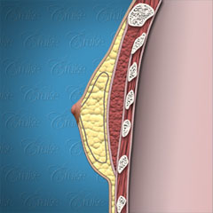 Nipple placement in fatty gynecomastia
